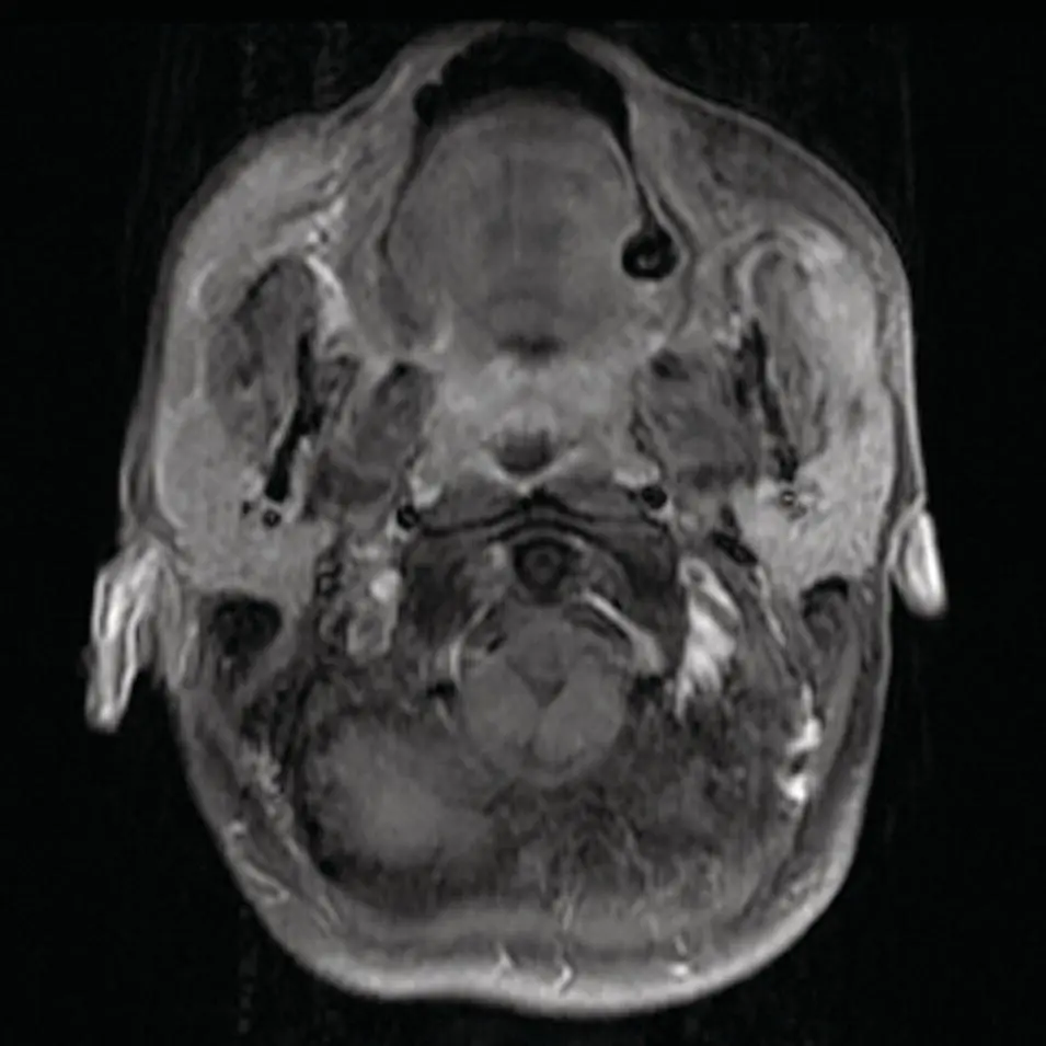 Figure 253Axial contrastenhanced fat saturated T1 MRI demonstrating - фото 73
