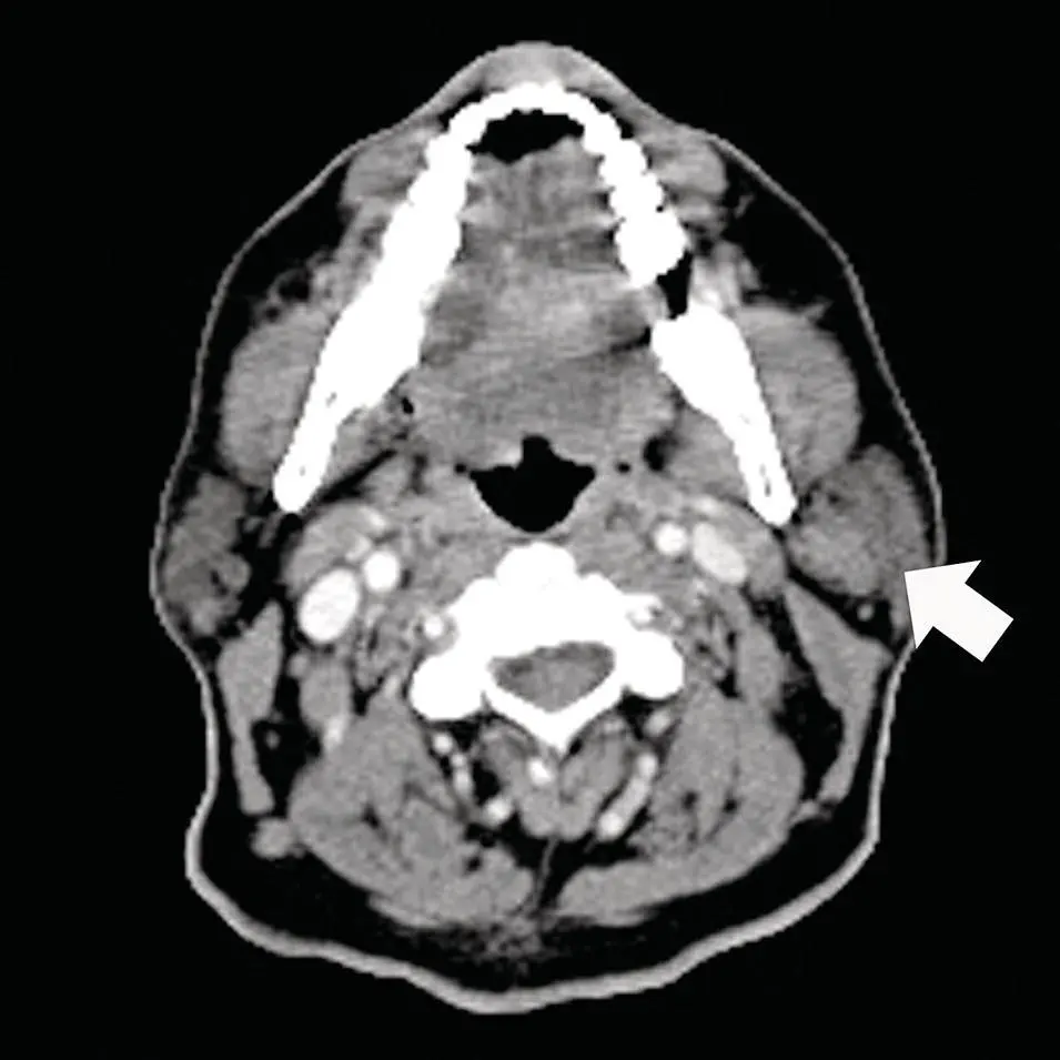 Figure 279 Axial CT scan with contrast at the level of the parotid tail - фото 99