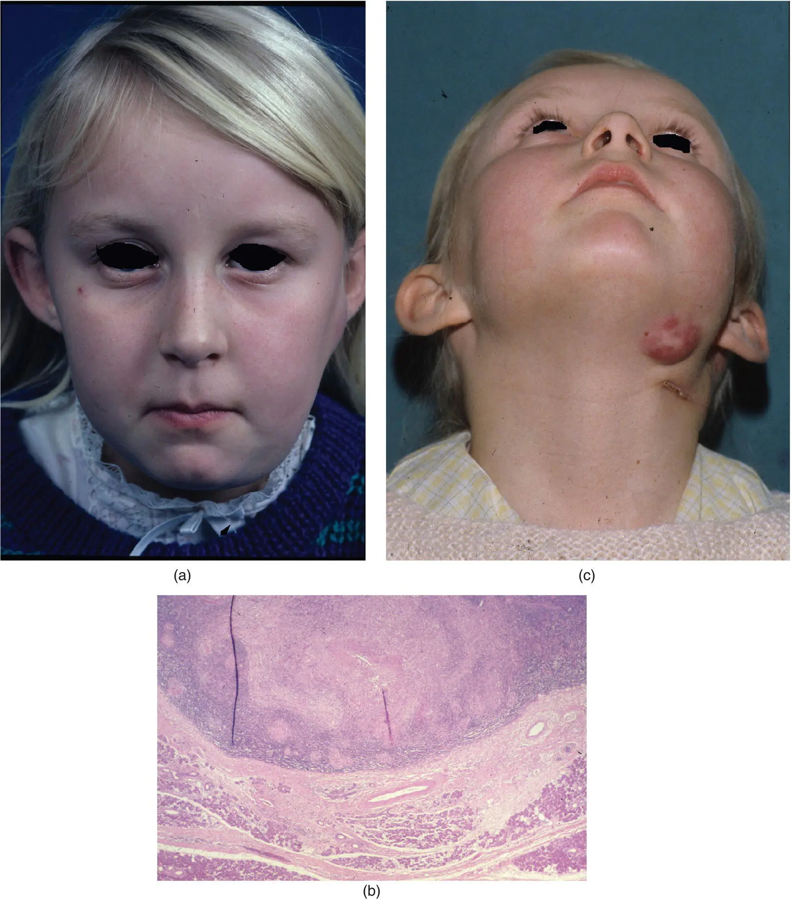 Figure 317 A 9yearold girl with a left parotid swelling with overlying - фото 134