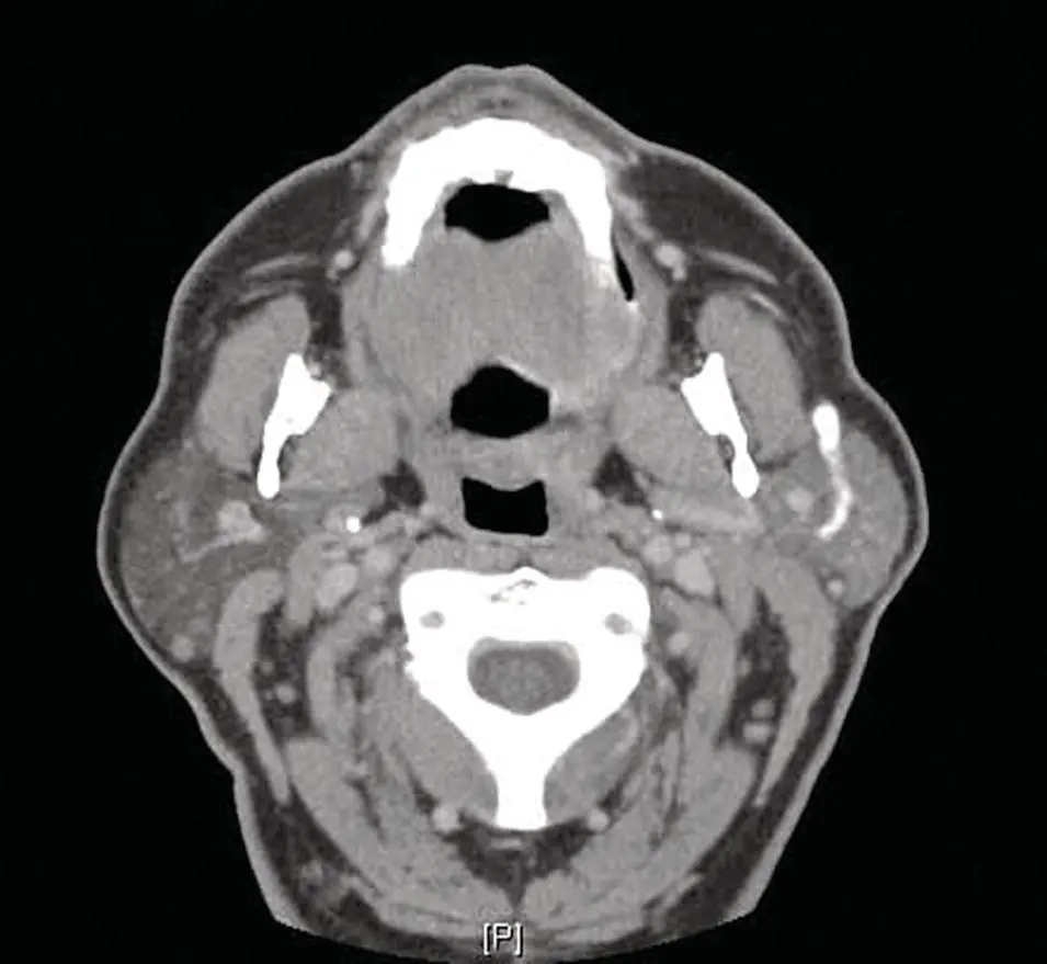 Figure 224 Parotid sialoCT Although the main duct is opacified it is - фото 44