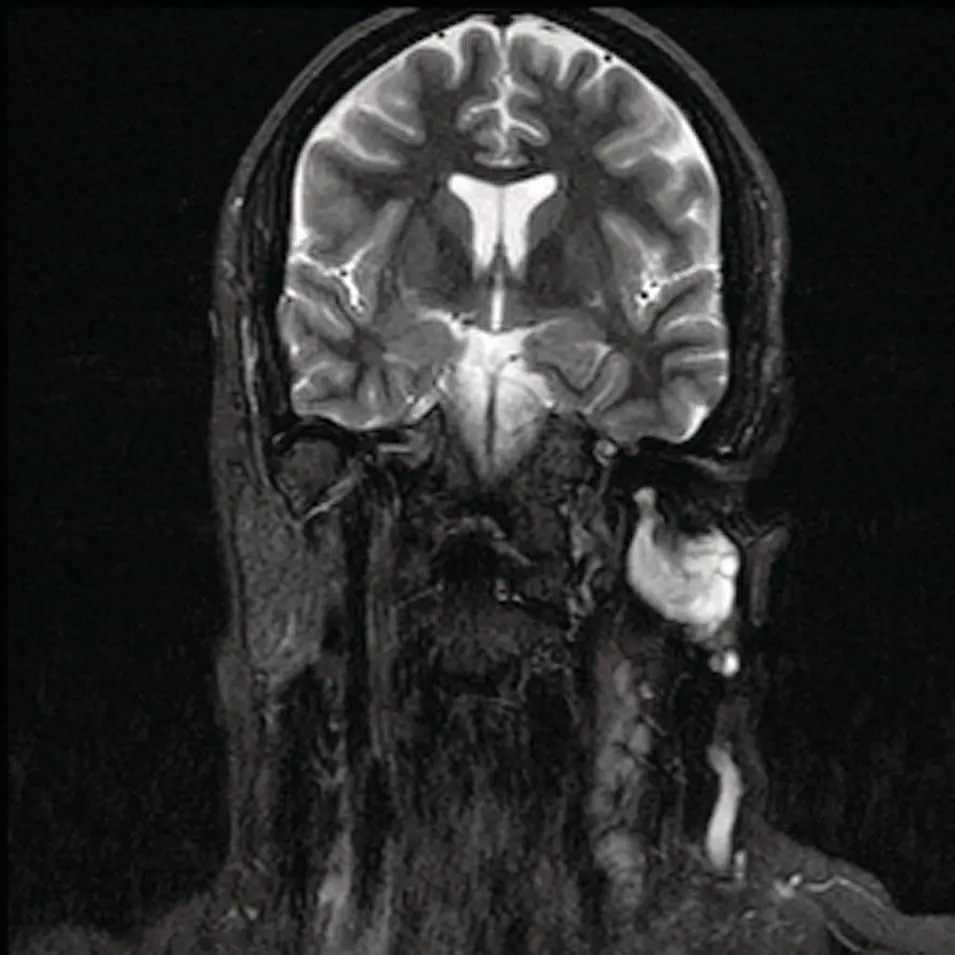 Figure 275Coronal T2 MRI corresponding to the case illustrated in Figure - фото 95