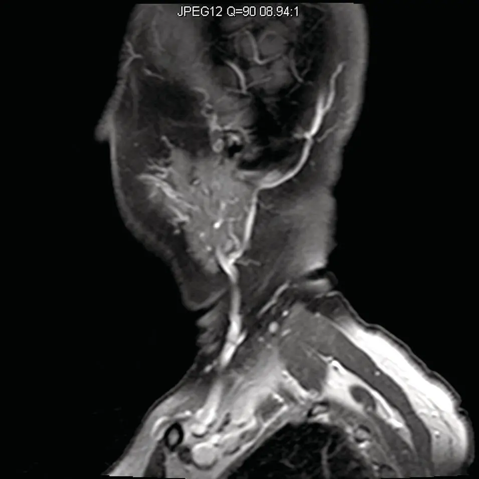 Figure 235Sagittal fat suppressed T1 MRI image of the parotid gland - фото 55