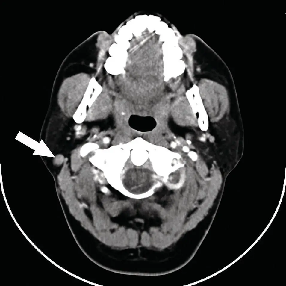 Figure 282 Axial CT of a mass in the right parotid gland with homogenous - фото 102