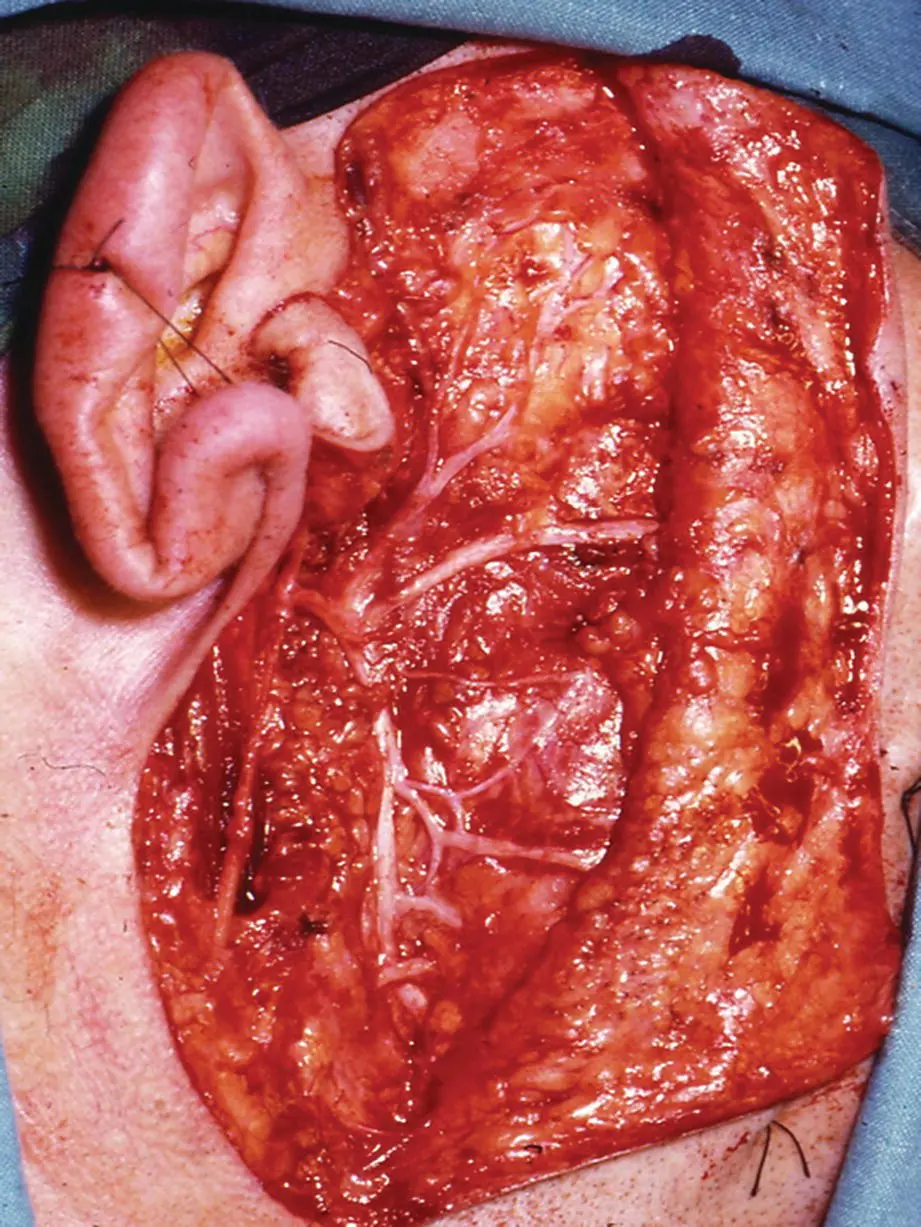 Figure 15 Clinical photograph of dissected facial nerve following superficial - фото 10