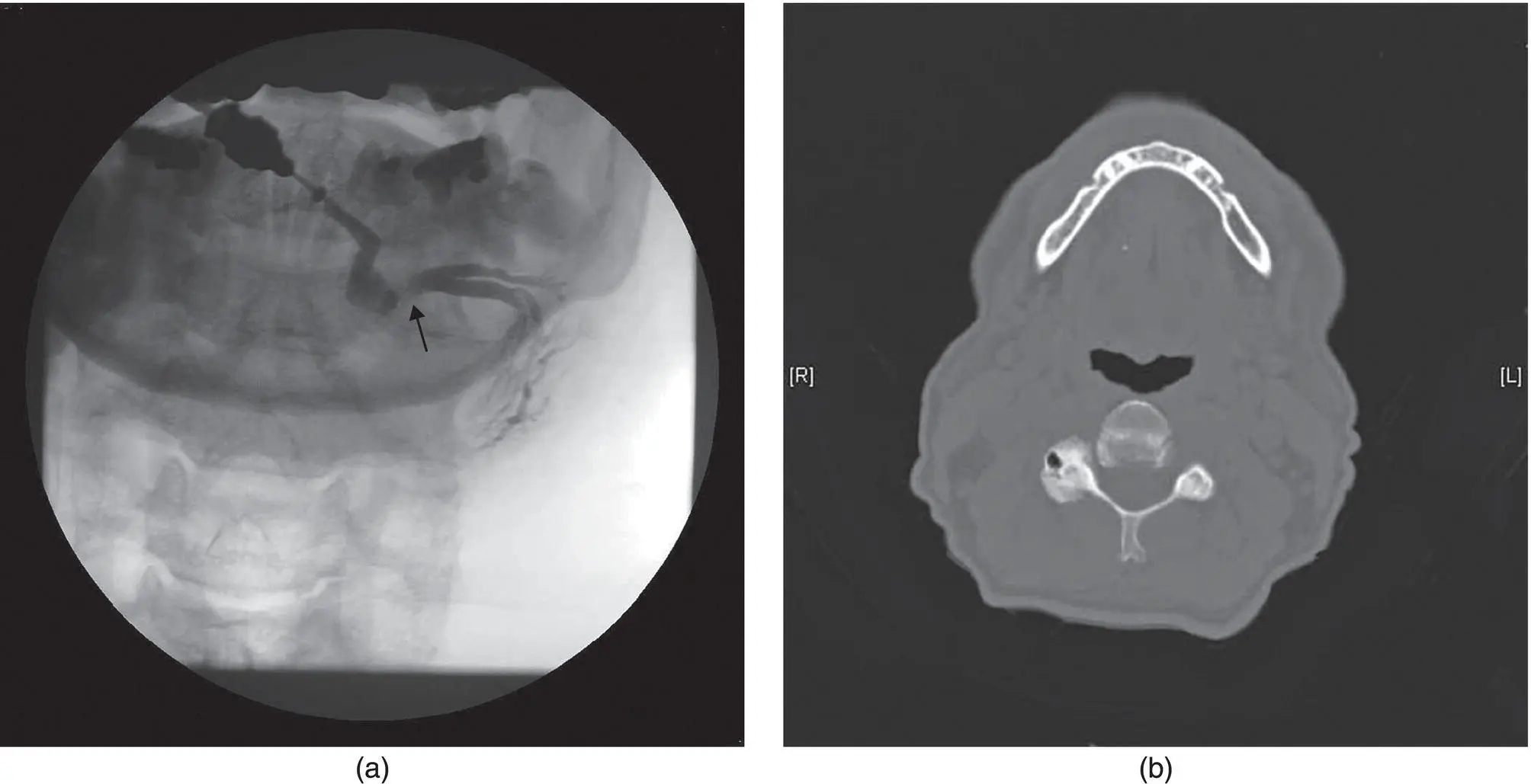 Figure 220 Submandibular sialogram a Note the continuity defect that - фото 40