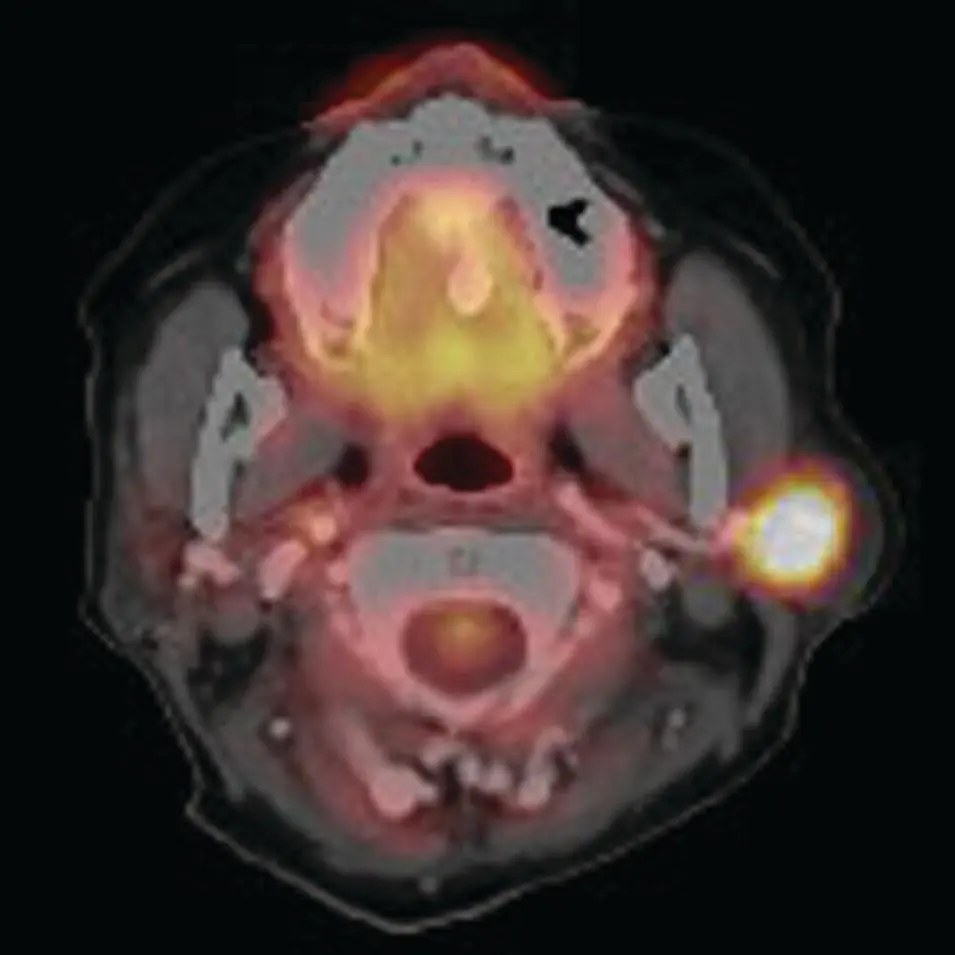 Figure 262 Axial PETCT fused image demonstrating intense FDG uptake in a - фото 82