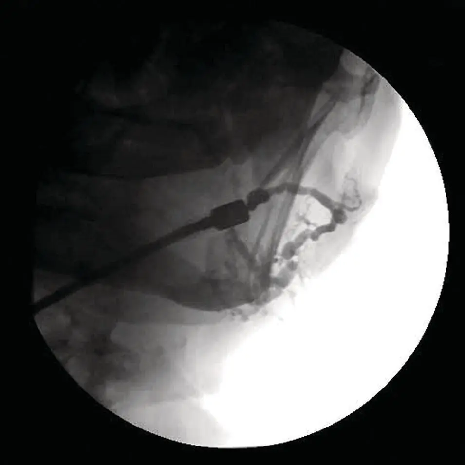 Figure 221 Parotid sialogram Note the numerous areas of duct dilatation and - фото 41