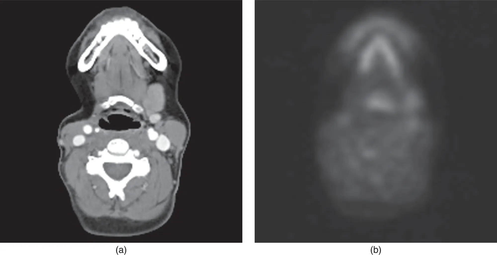 Figure 243 Axial CT a and corresponding PET b of the submandibular gland - фото 63