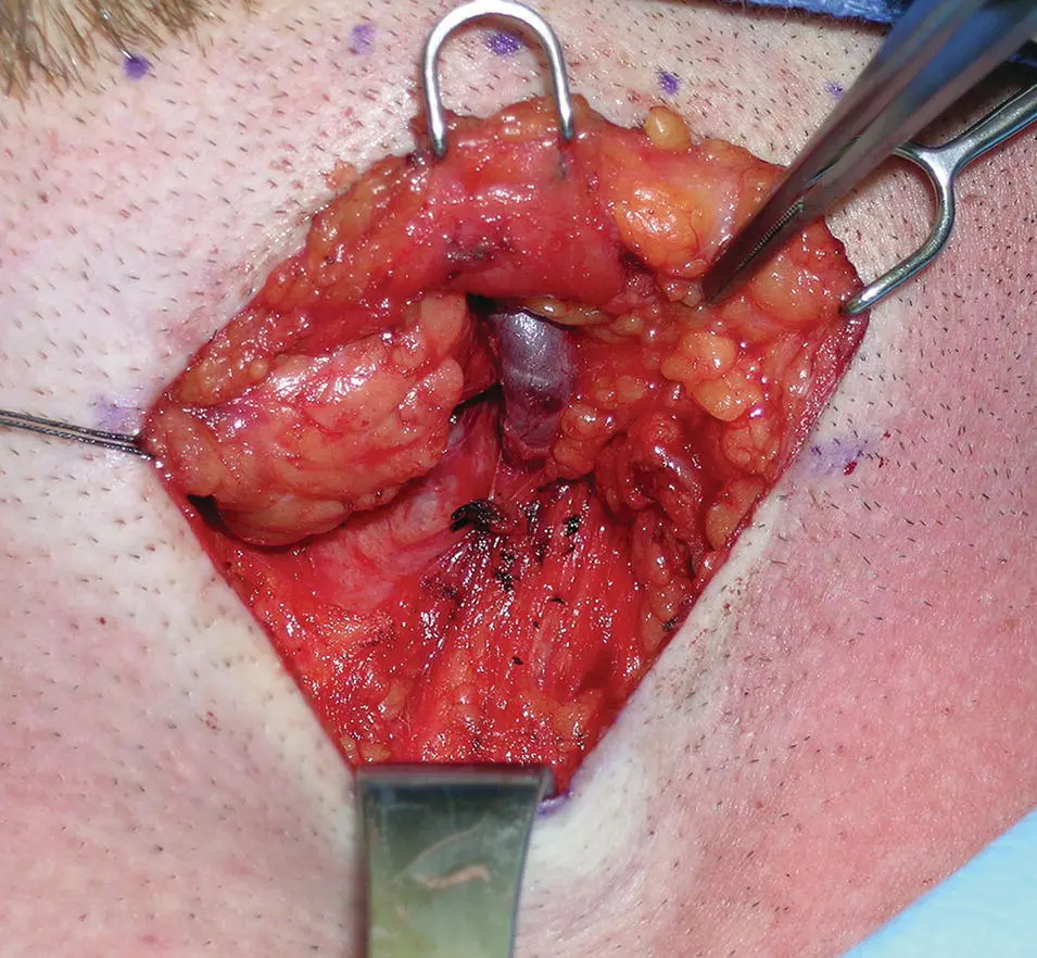 Figure 111 Superficial dissection of the left submandibular gland The - фото 16