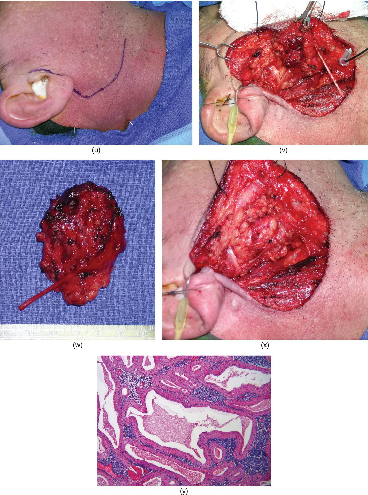 Figure 285 The patient demonstrates obvious left facial swelling in the - фото 110