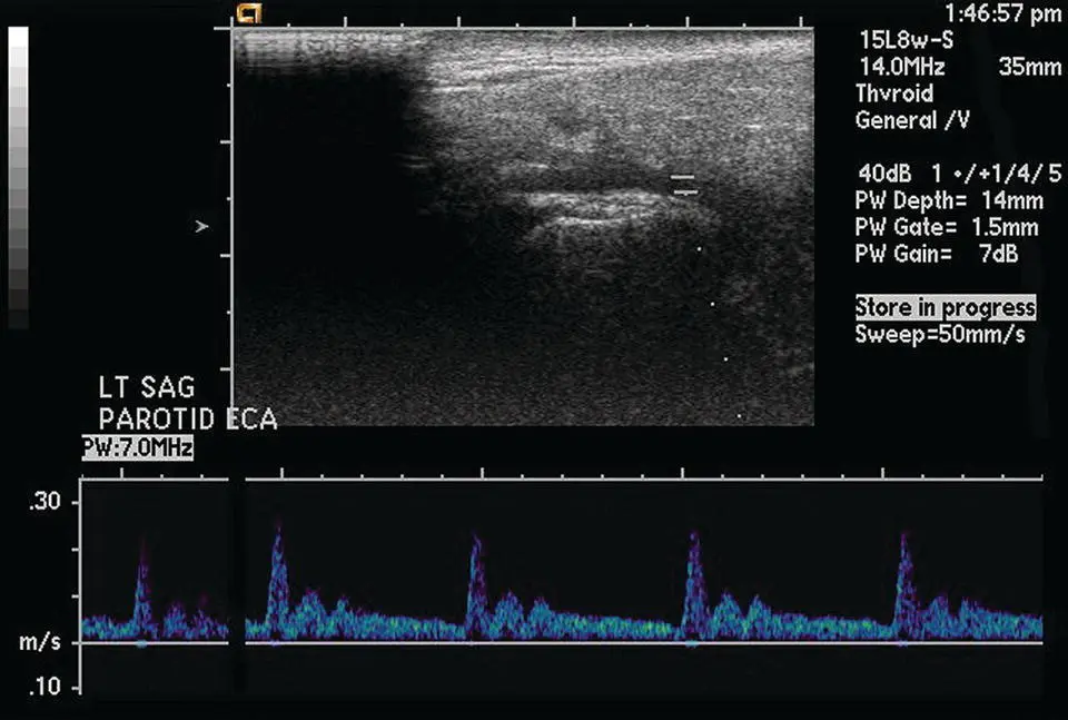 Figure 218 Ultrasound of the parotid gland in longitudinal orientation - фото 38