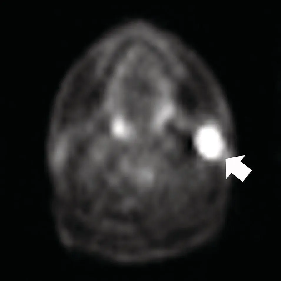 Figure 280Axial PET scan image corresponding to the case in Figure 279 A - фото 100