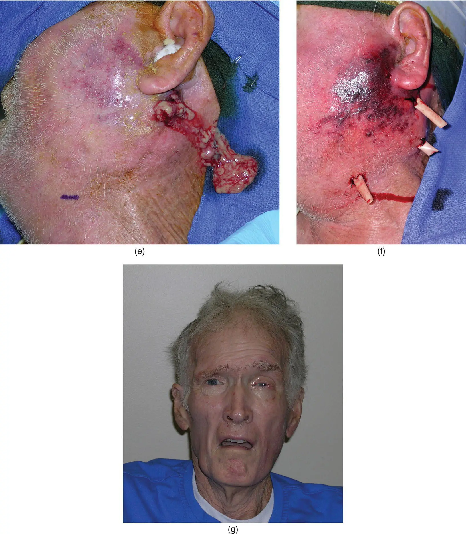 Figure 321 A 71yearold man a demonstrated significant left facial - фото 139