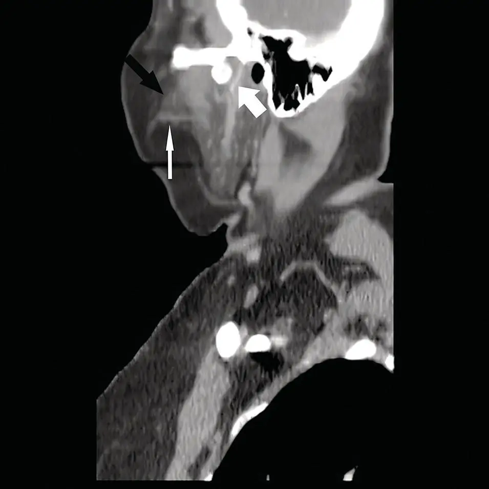 Figure 26 Sagittal CT reformation of the neck in softtissue window at the - фото 26