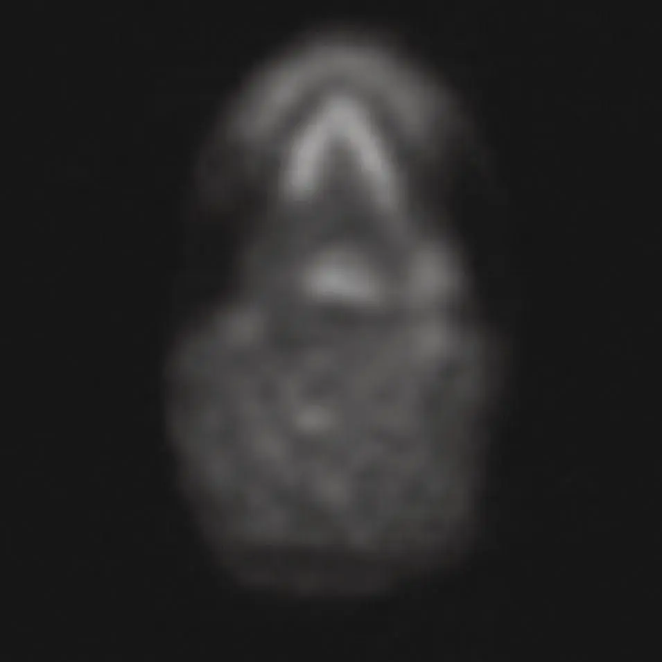 Figure 246 Axial PET of the sublingual gland demonstrating the intense uptake - фото 66