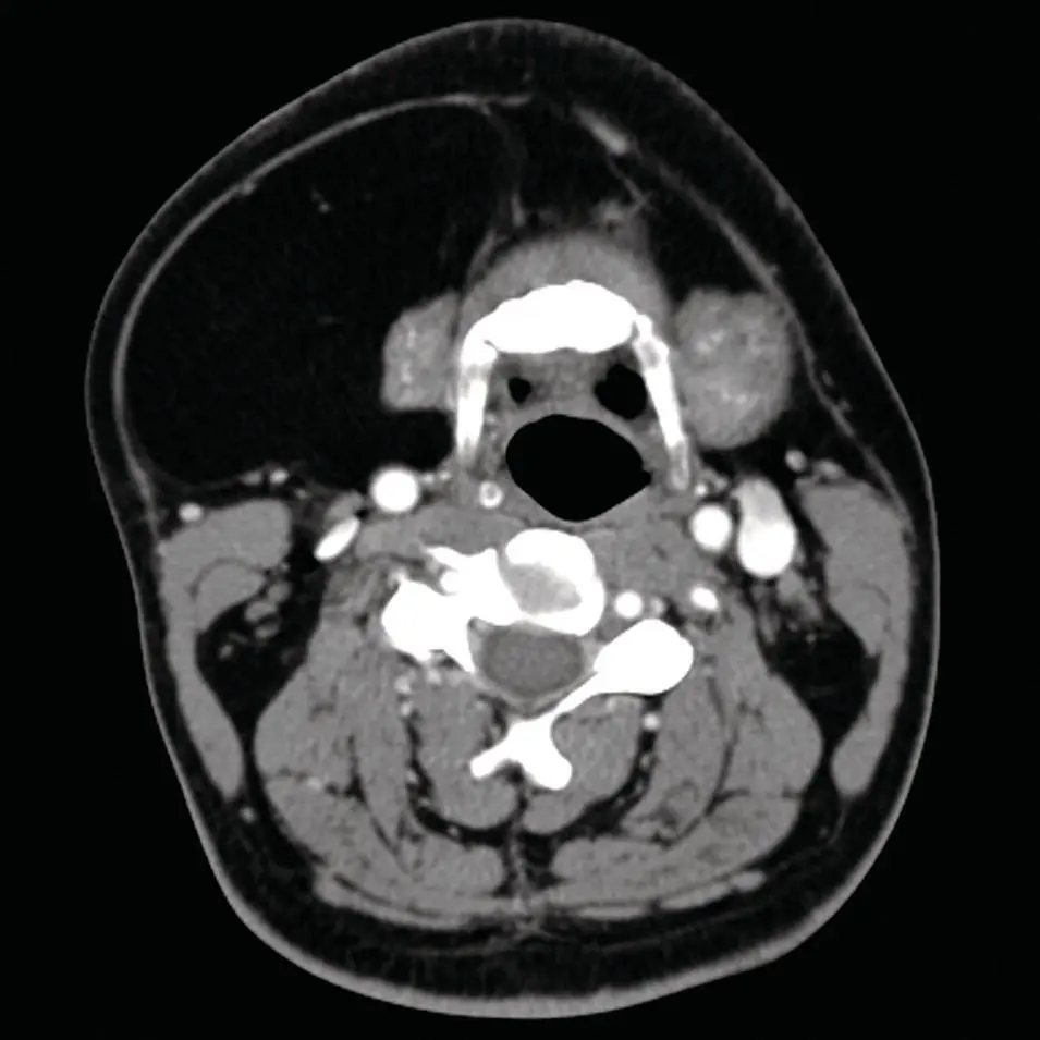 Figure 273 Axial contrastenhanced CT through the submandibular gland with - фото 93