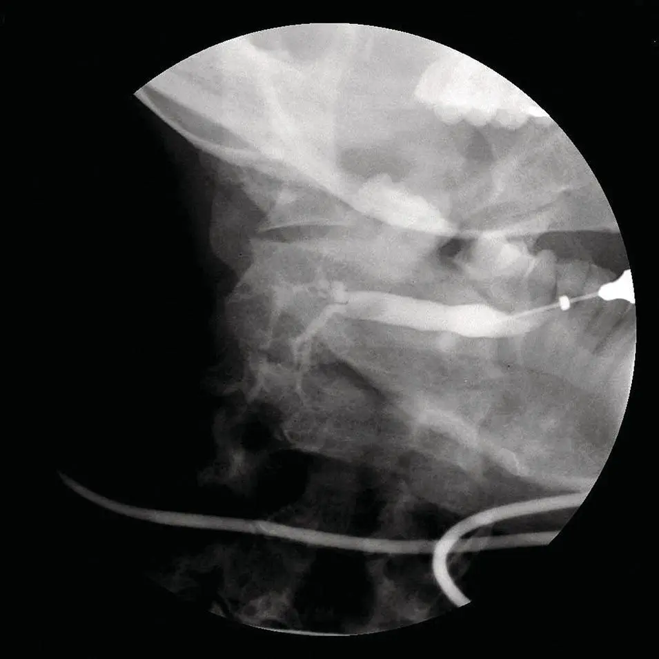Figure 222 Submandibular sialogram Note the soft noncalcified stone - фото 42