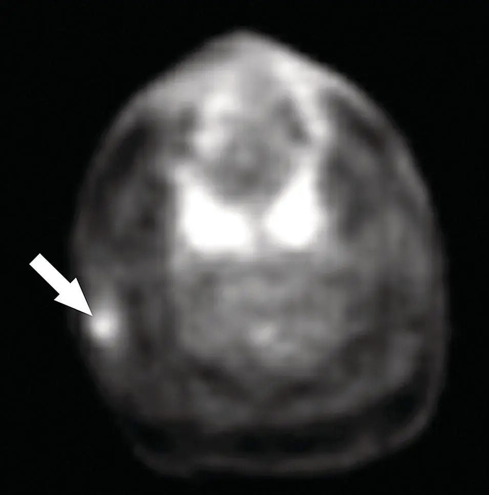 Figure 283Axial PET scan corresponding to the case illustrated in Figure - фото 103