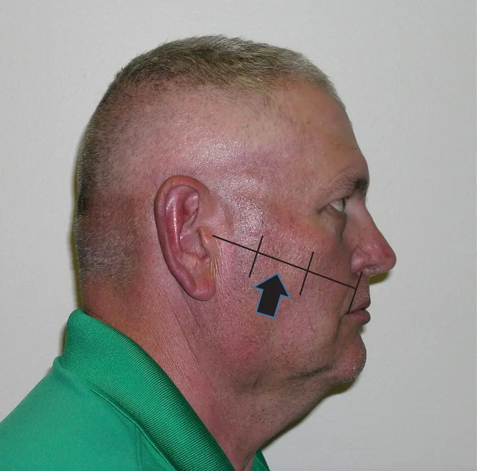 Figure 18 The surface markings for the location of the parotid duct Nerve - фото 13