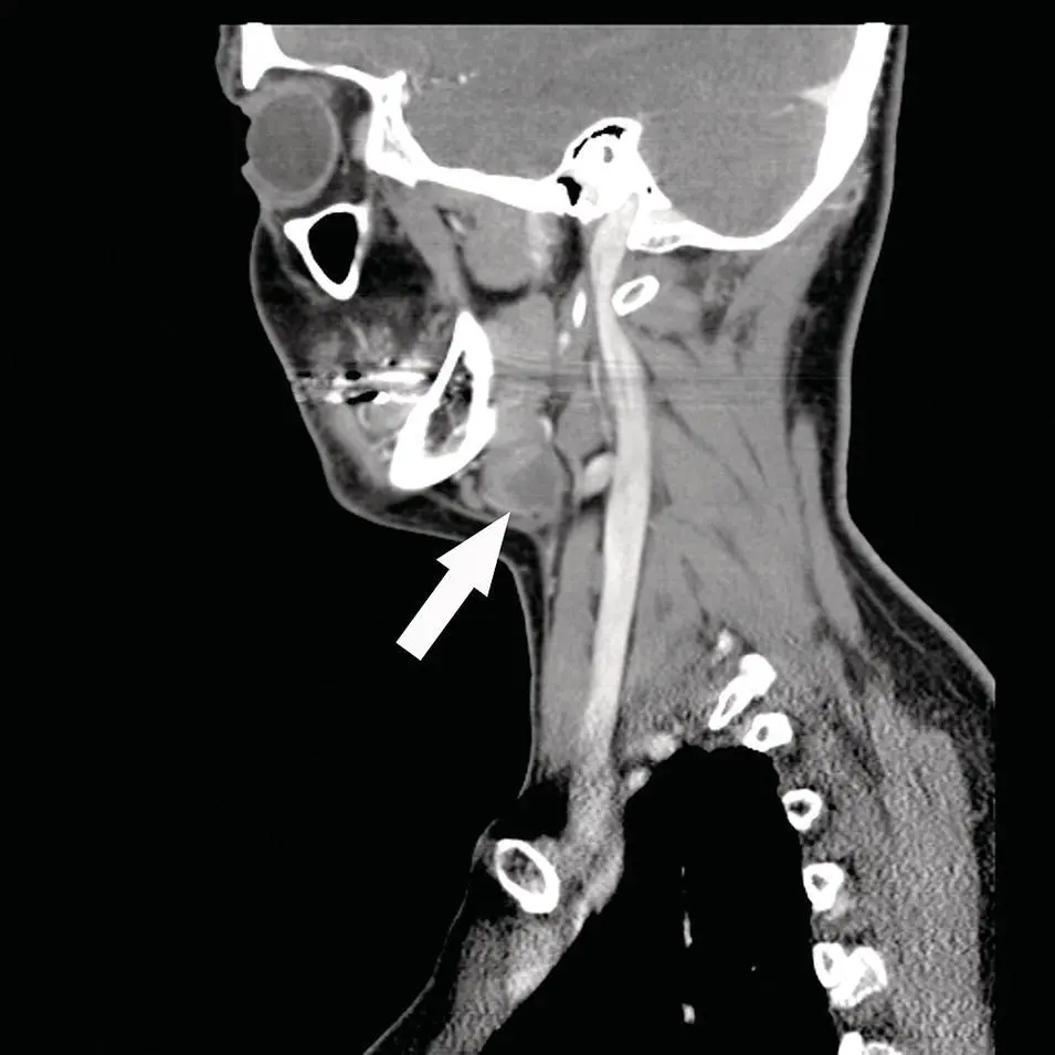 Figure 271 Reformatted sagittal contrastenhanced CT corresponding to the - фото 91