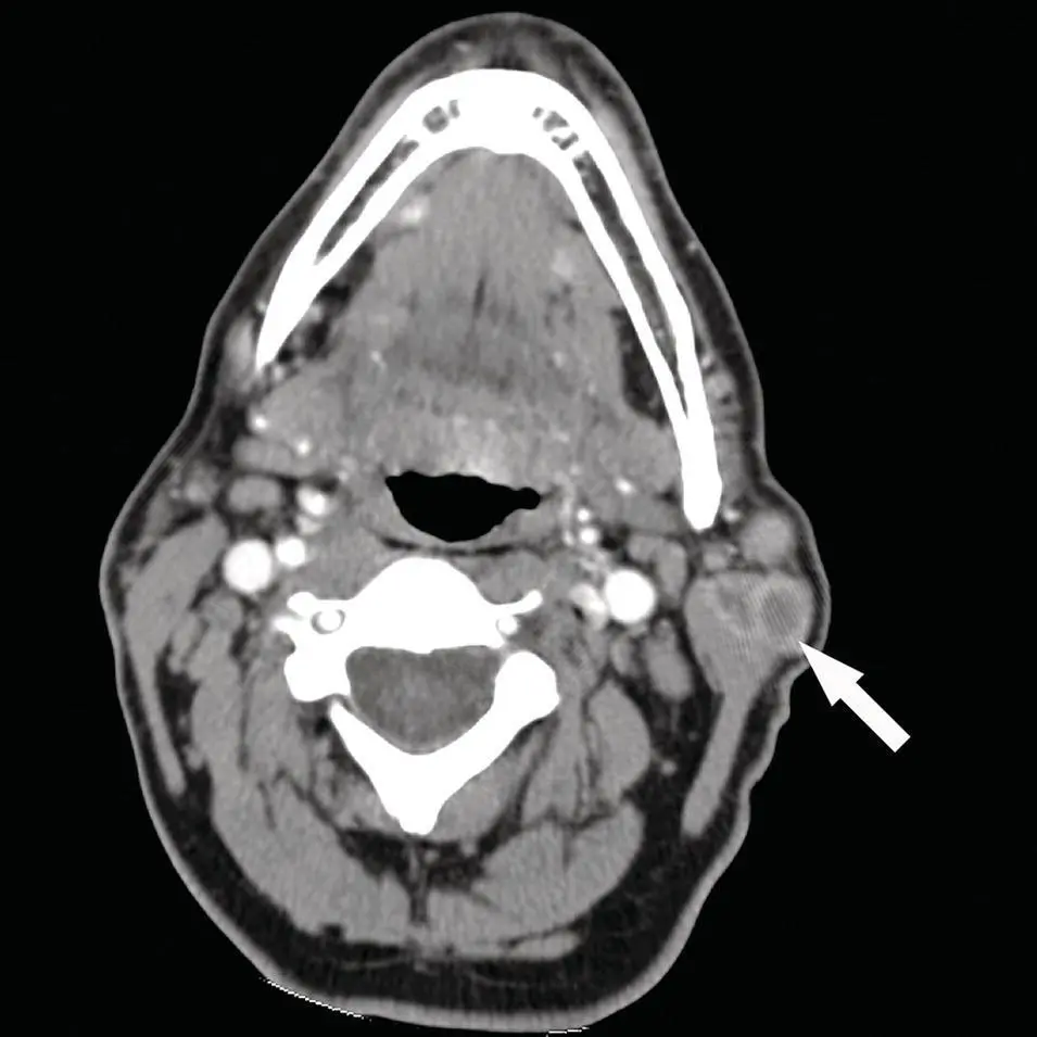 Figure 263 Axial contrastenhanced CT of a heterogenous parotid mass at the - фото 83
