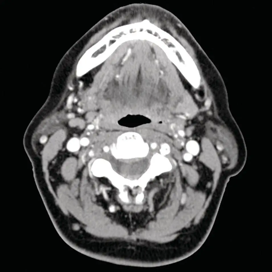 Figure 244 Axial CT of the neck at the level of the sublingual gland - фото 64