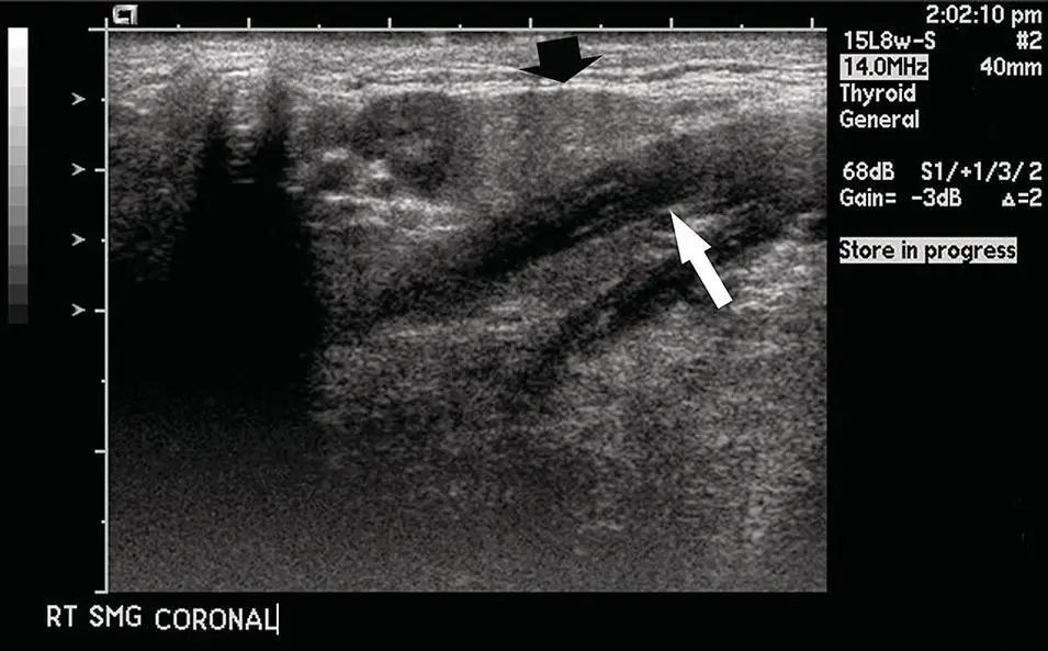 Figure 216 Ultrasound of the submandibular gland black arrow adjacent to - фото 36