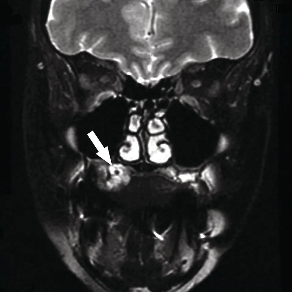 Figure 251 Coronal fat saturated T2 MRI image demonstrating a welldemarcated - фото 71