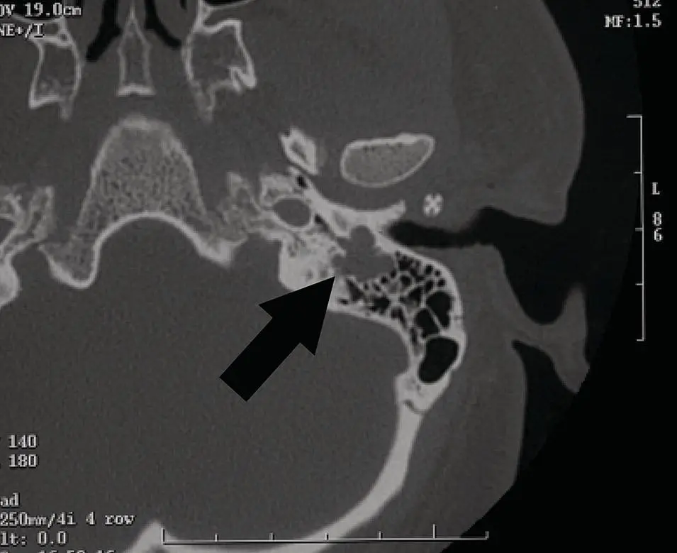 Figure 276 Axial CT at the skull base displayed in bone window showing - фото 96