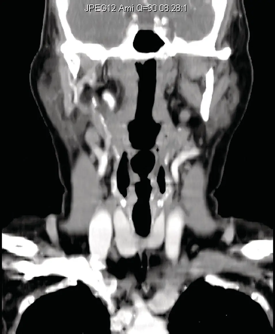 Figure 231Reformatted coronal CT of the neck at the level of the parotid - фото 51