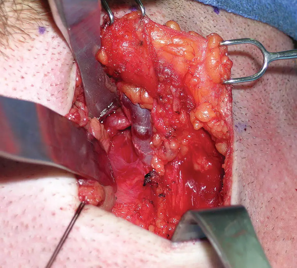 Figure 112 Deep dissection of the left submandibular gland With the - фото 17