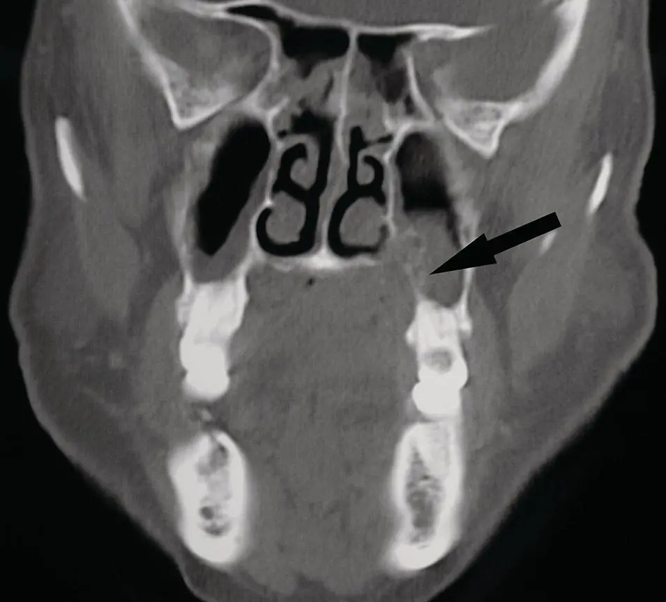 Figure 269Coronal CT corresponding to the case illustrated in Figure 268with - фото 89