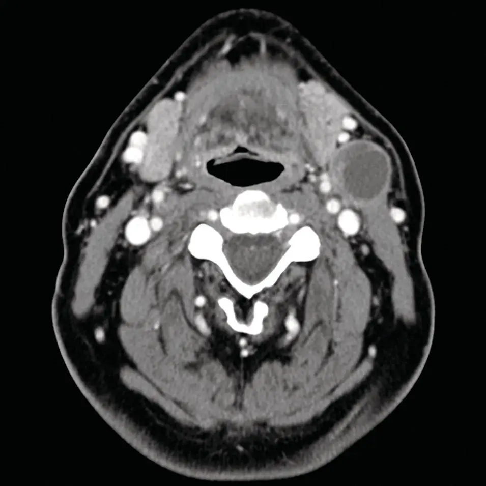 Figure 260 Axial contrastenhanced CT of the maxillofacial soft tissues with - фото 80