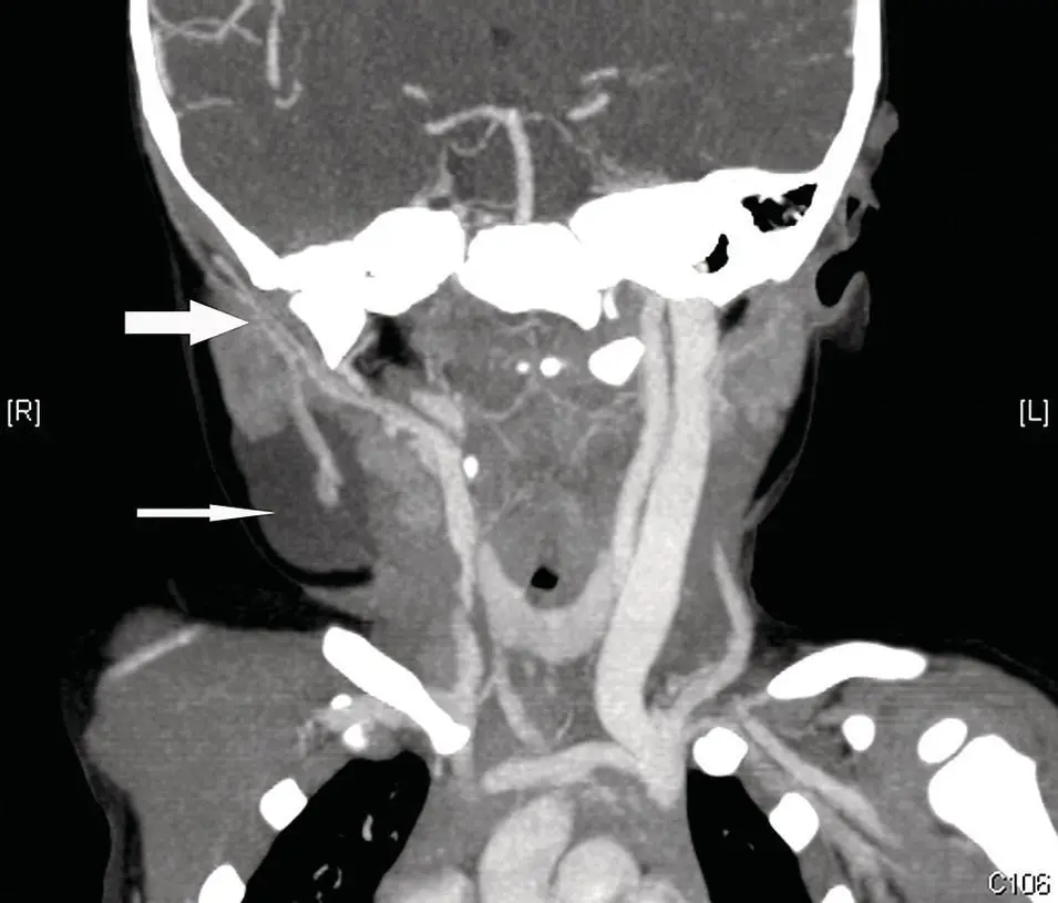 Figure 27 CT angiogram CTA of the neck at the level of the parotid gland - фото 27