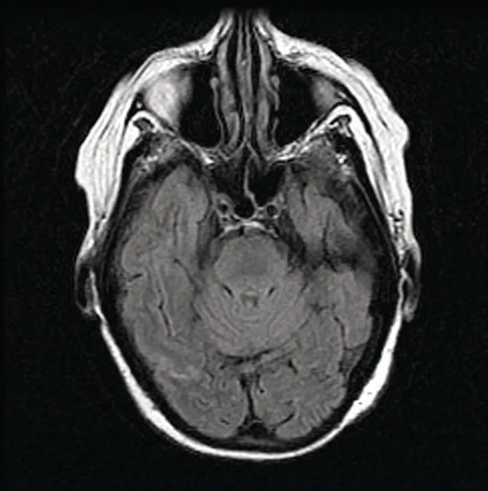 Figure 214 Axial MRI FLAIR image at the skull base demonstrating CSF - фото 34