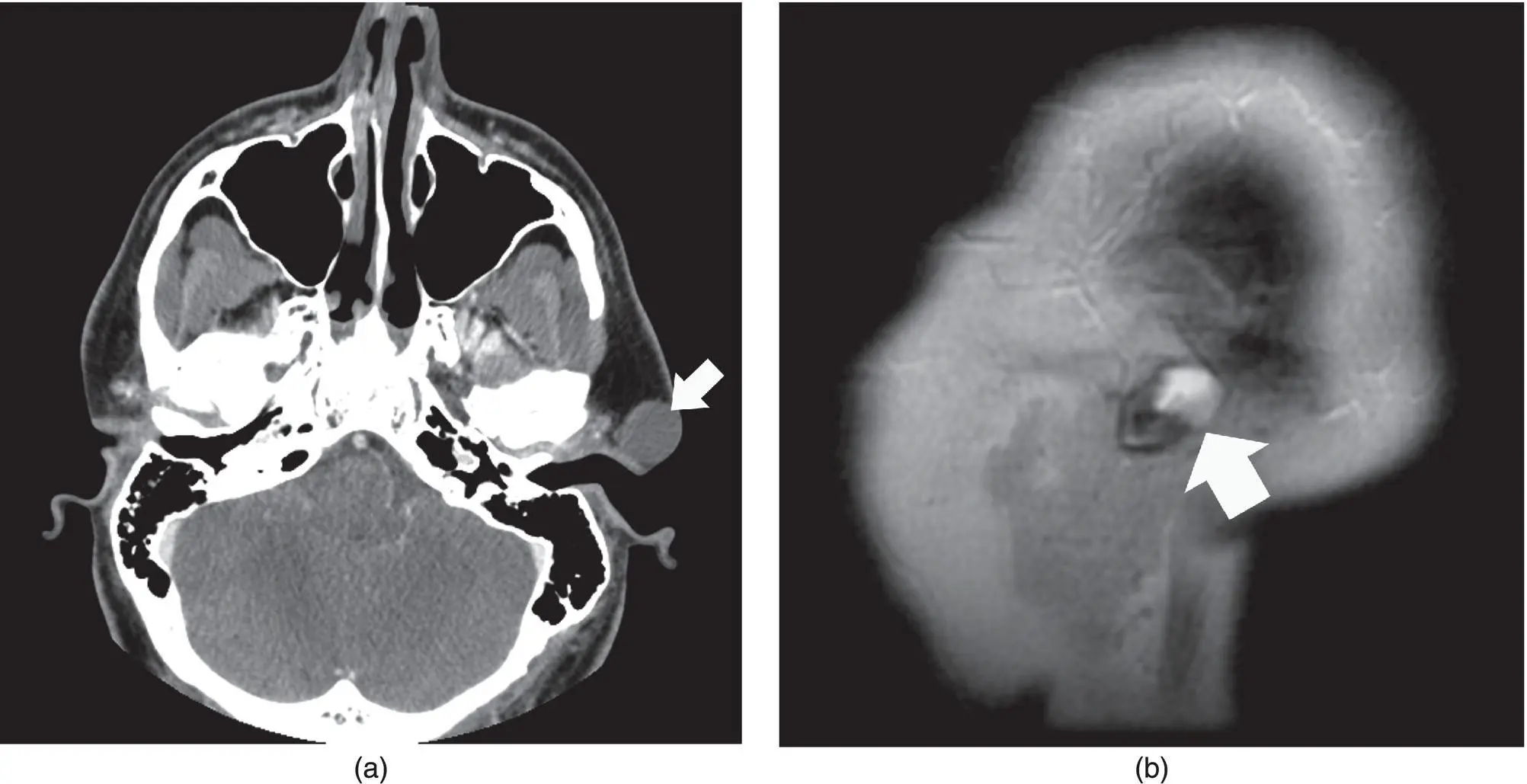 Figure 259 Axial contrastenhanced CT a of the head with a cystic mass at - фото 79