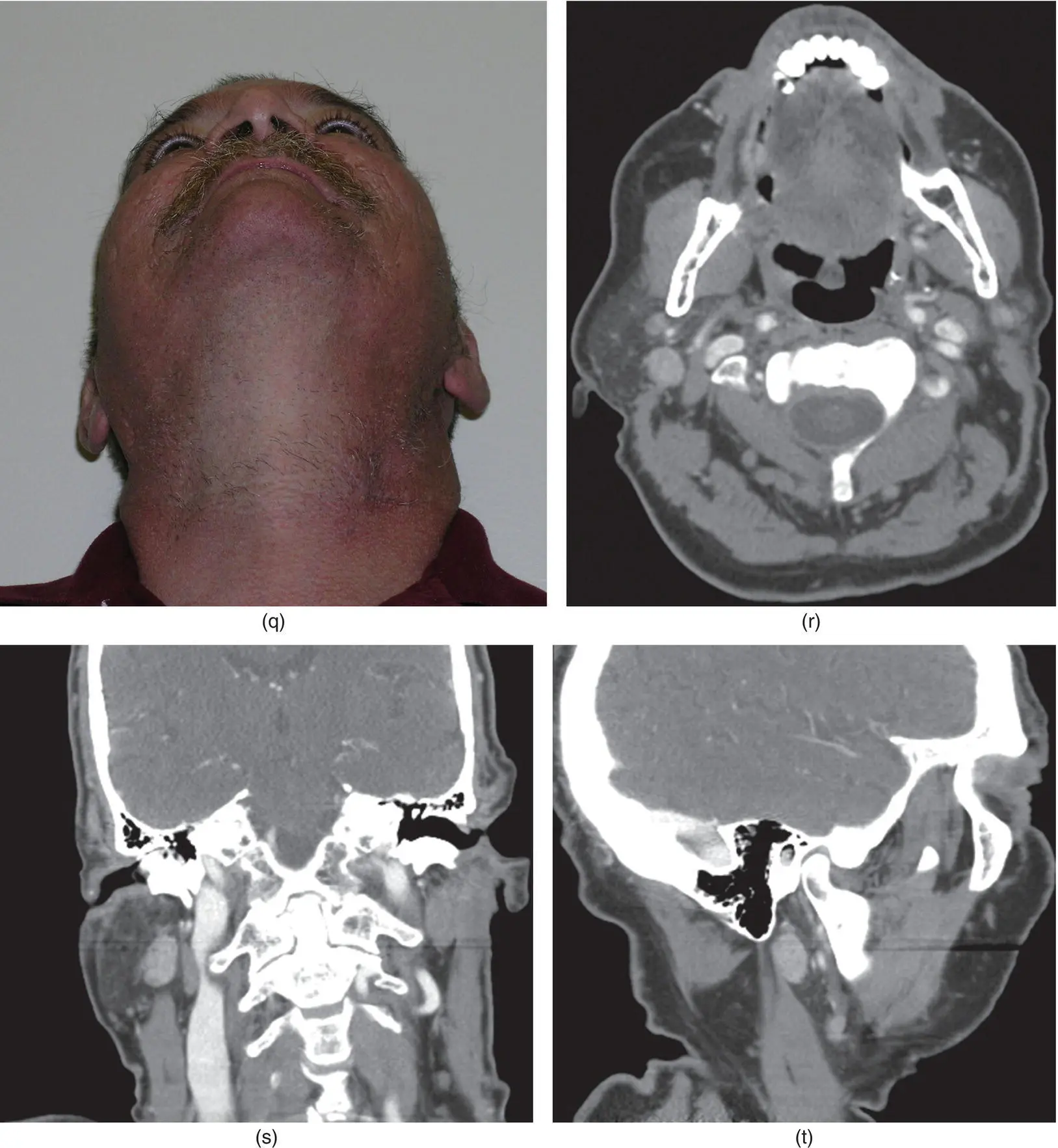Figure 285 The patient demonstrates obvious left facial swelling in the - фото 109