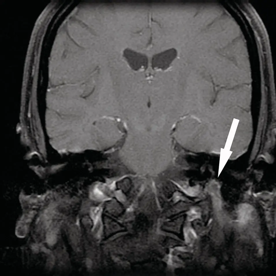 Figure 274 Coronal T1 contrastenhanced MRI demonstrating a mass in the left - фото 94