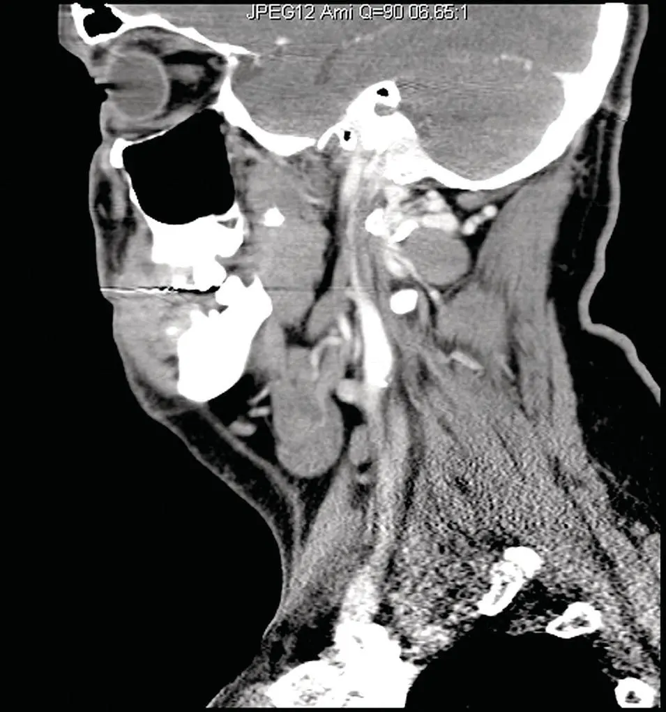 Figure 239Reformatted sagittal CT at the level of the submandibular gland - фото 59