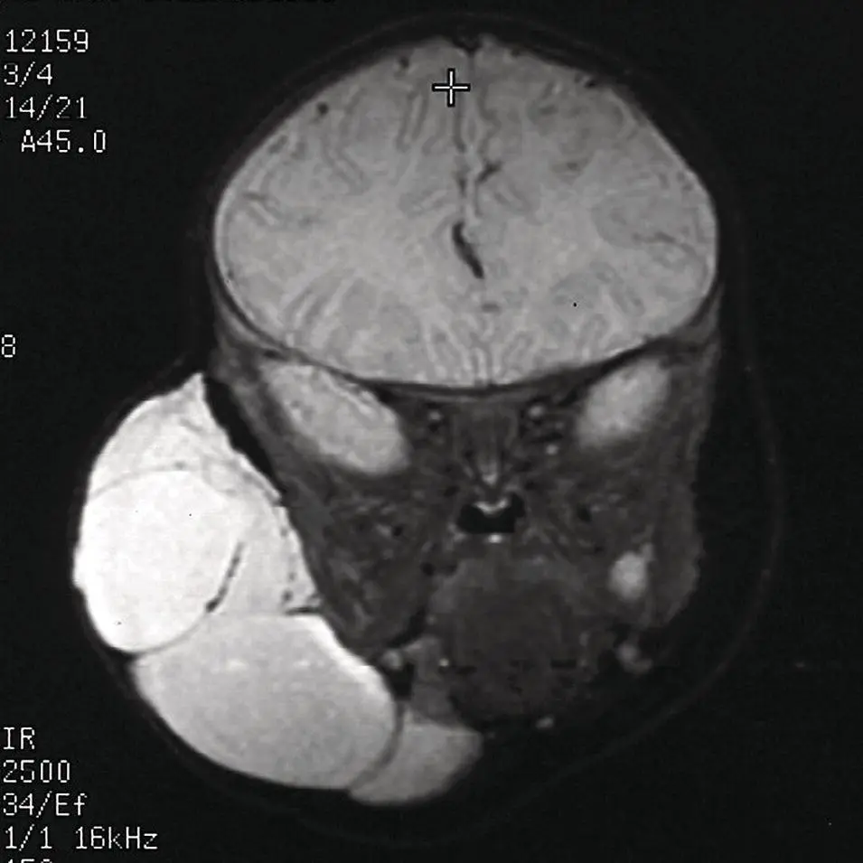 Figure 248 Coronal STIR MRI of the face of a different patient with a very - фото 68
