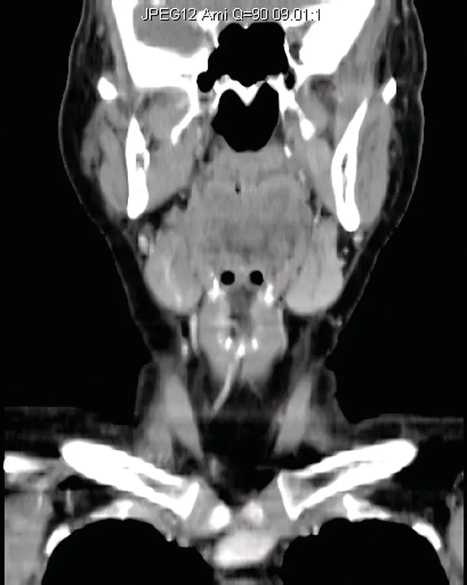 Figure 238Reformatted coronal CT at the level of the submandibular gland - фото 58