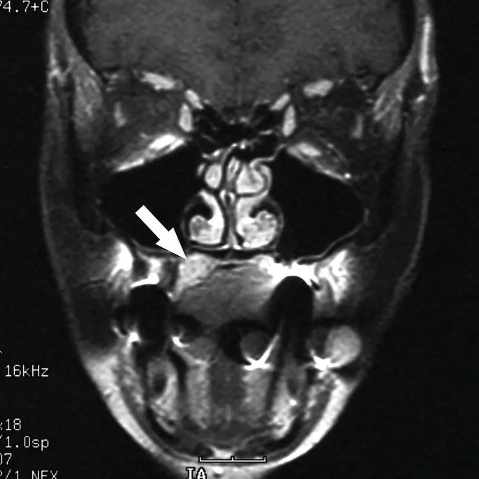 Figure 250Coronal fat suppressed contrastenhanced T1 MRI image corresponding - фото 70
