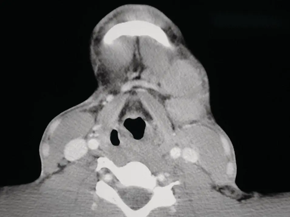Figure 265Axial contrastenhanced CT demonstrating large bulky cervical - фото 85
