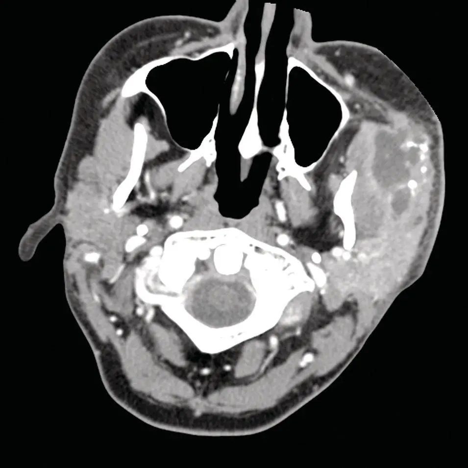 Figure 252 Axial CT with contrast at the level of the masseter muscles - фото 72