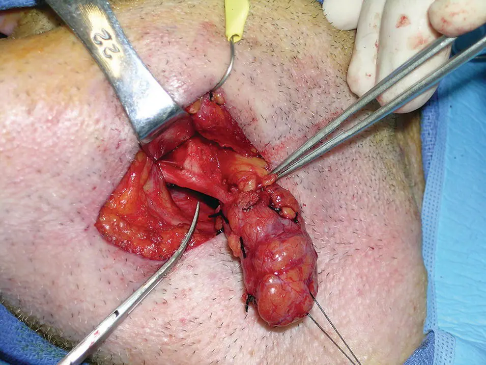 Figure 113 Clinical photograph showing the relationship of the lingual nerve - фото 18
