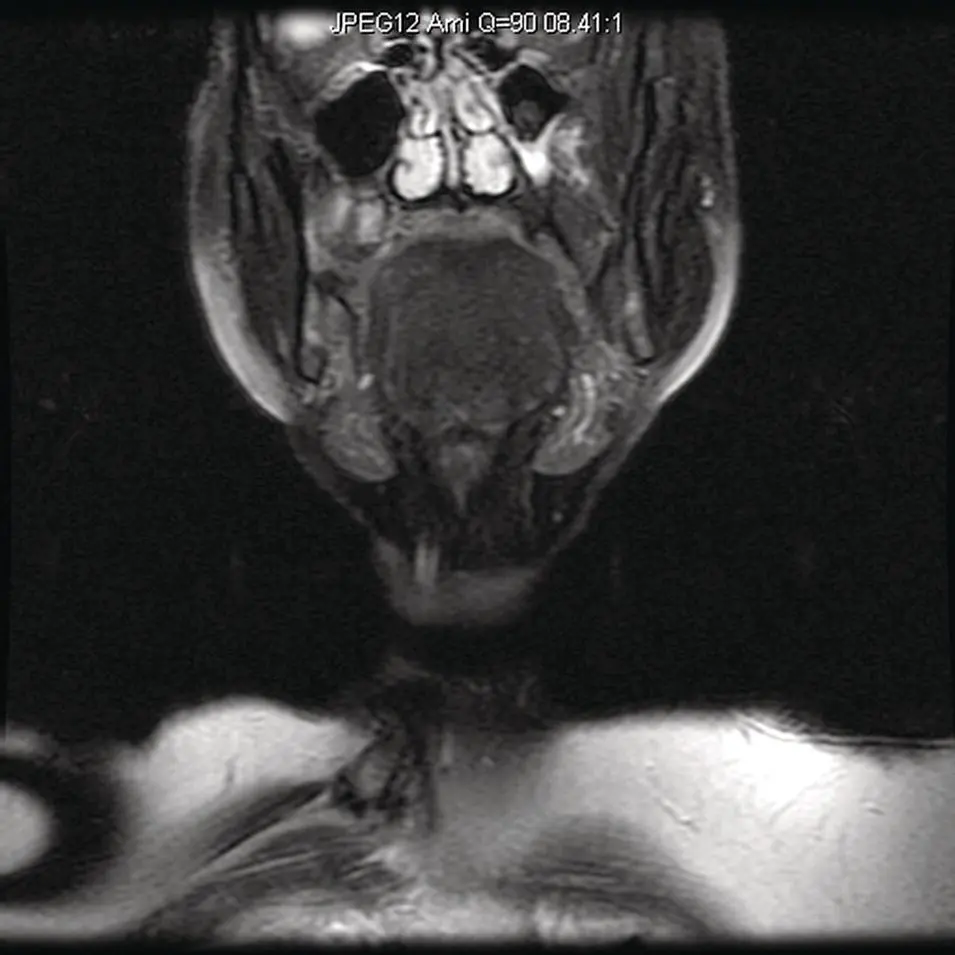 Figure 241Coronal fat saturated T2 MRI of the submandibular gland Note the - фото 61
