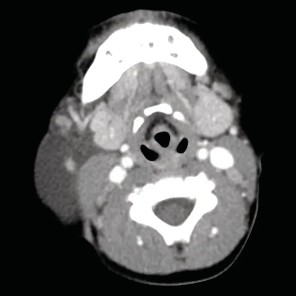 Figure 247 Axial contrastenhanced CT of the neck at the level of the - фото 67
