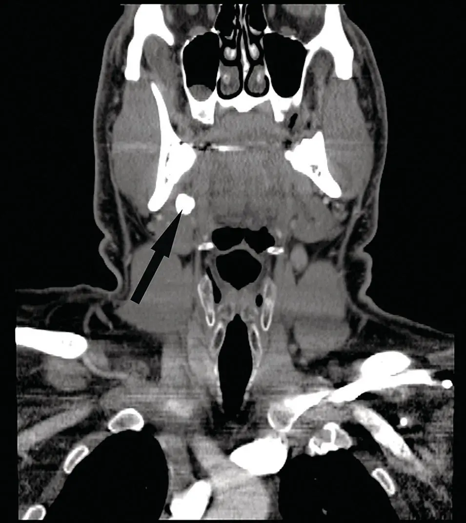 Figure 256 Reformatted coronal contrastenhanced CT of the submandibular - фото 76