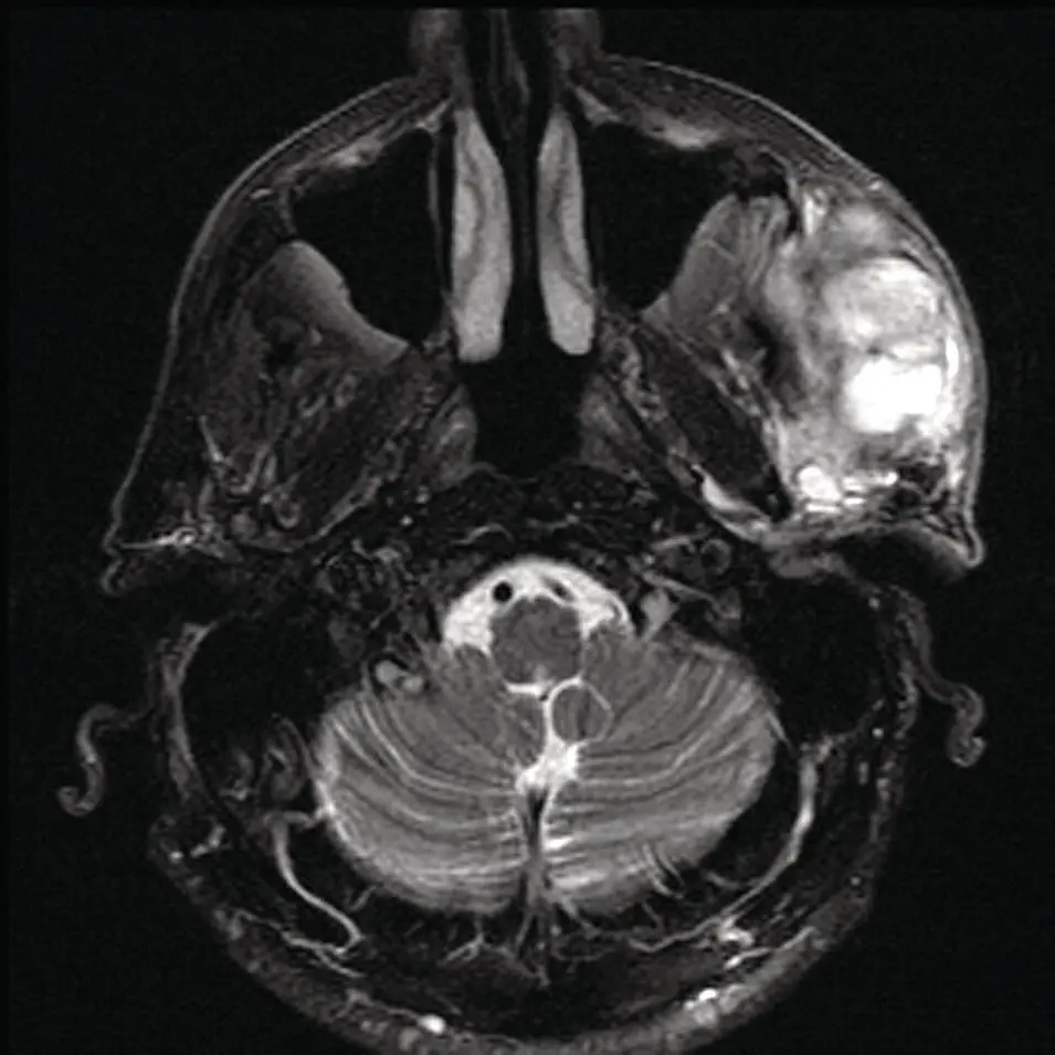 Figure 278 Axial T2 MRI image corresponding to the case illustrated in Figure - фото 98