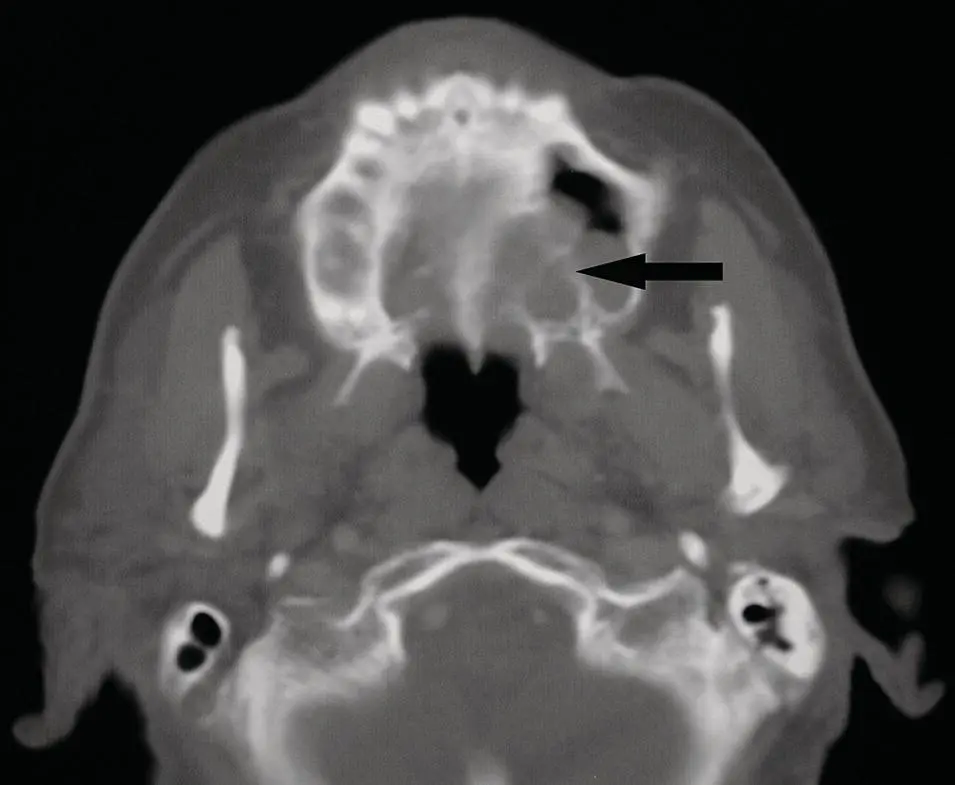 Figure 268 Axial CT in bone window demonstrating a mass eroding through the - фото 88
